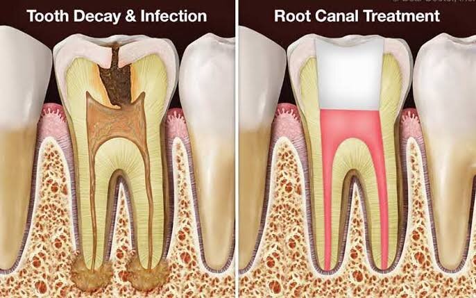 Root Canal Treatment